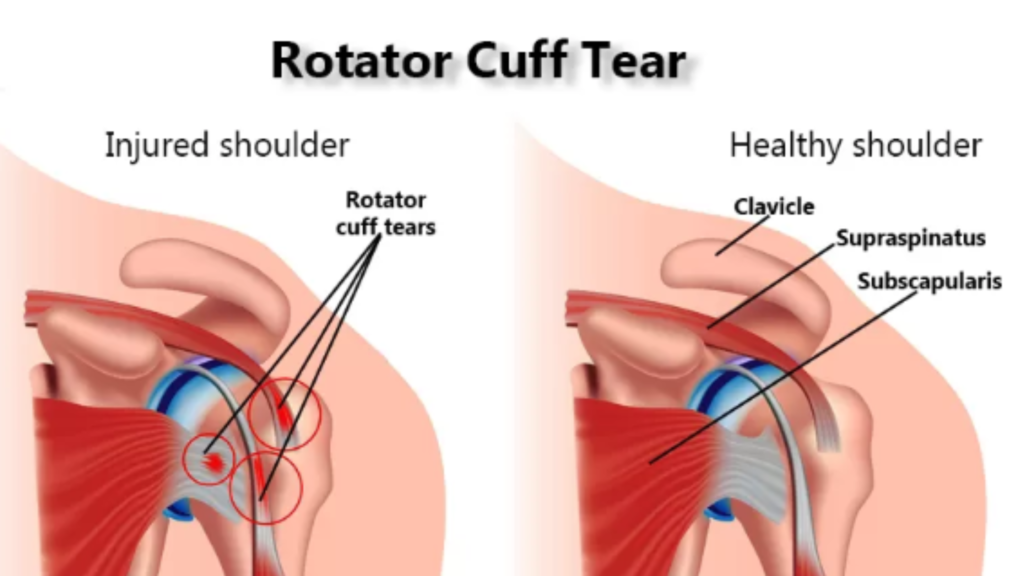https://donkellypainrelief.ie/wp-content/uploads/2023/08/Rotator-Cuff-Treatment-1024x576.png