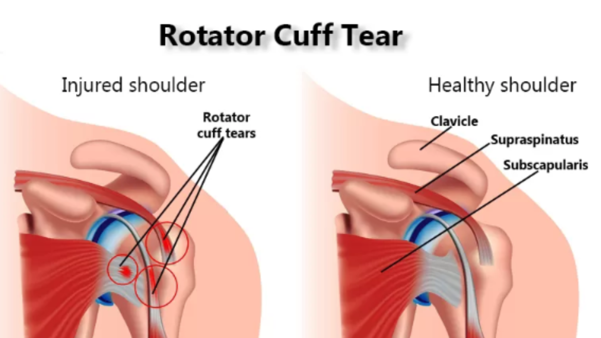 Treatments for a Rotator Cuff Injury Don Kelly Pain Relief Most