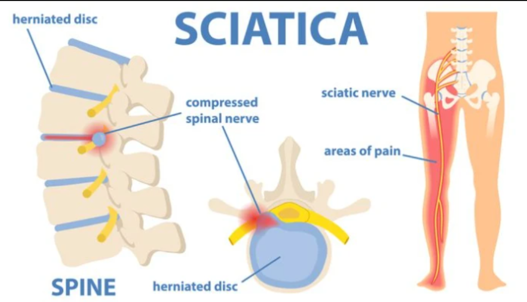 Sciatica, How Physiotherapy Management helps in Relieving the Sciatic  Nerve Pain?