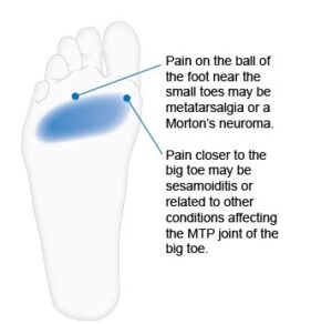 heel pain clinic Limerick