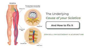 Are you experiencing a sharp, shooting pain that starts in your lower back and travels down your leg? Does sitting for more than ten minutes feel like an impossible task? You aren't alone. Sciatica is one of the most common reasons patients visit our clinics in Limerick (Dooradoyle) and Charleville.