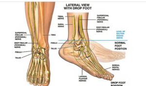 MS and sensory changes in the feet